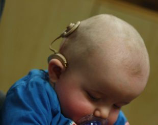 infant_with_cochlear_implant